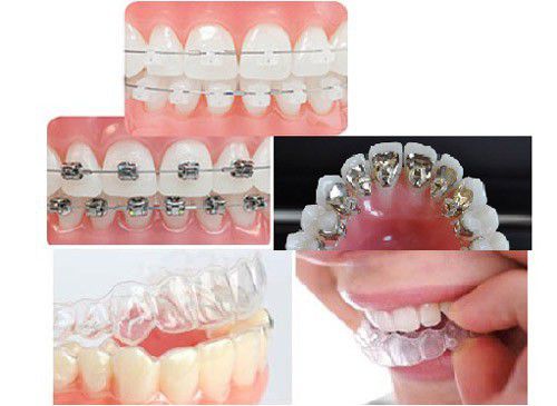 Có nhiều phương pháp niềng răng với mức chi phí khác nhau
