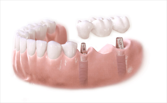 Implant phương pháp phục hình răng hiện đại