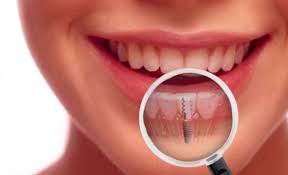 Implant phương pháp trồng răng hiệu quả