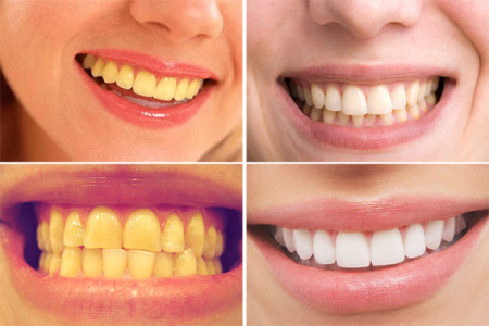 Bọc răng sứ thẩm mỹ cho răng nhiễm màu nặng
