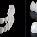 Những ưu điểm của phục hình răng sứ thẫm mỹ