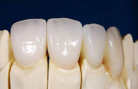 Răng toàn sứ venus có tốt không ?