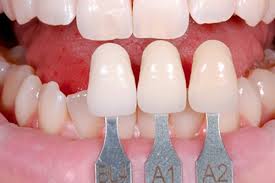 Bác sĩ sẽ lấy mô răng và gắn răng tạm để thay thế mô răng đã bị lấy đi