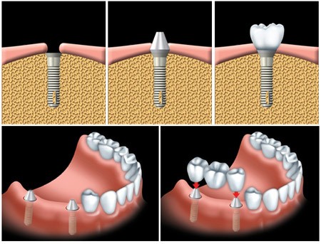 Cấy ghép implant phục hình răng đã mất