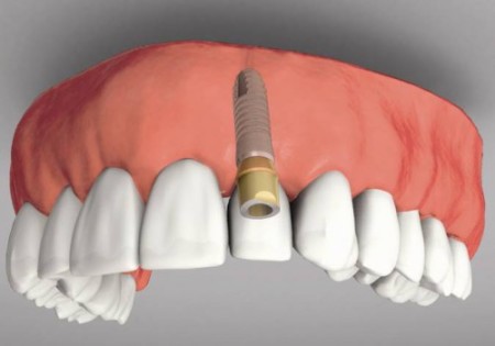 Trồng răng implant mang lợi ích cao cho người mất răng