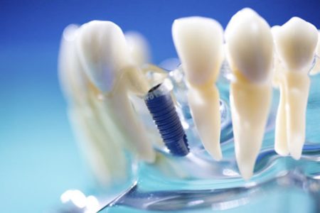 Trồng răng implant duy trì vĩnh viễn