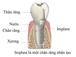Cấy ghép Implant an toàn tại nha khoa Đăng Lưu