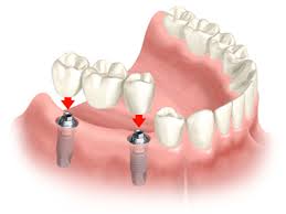 Răng cấy ghép Implant