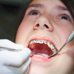 Niềng răng ở đâu tốt tại tphcm hiện nay nếu tiến hành?