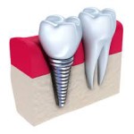 Lợi ích của trụ răng giả implant