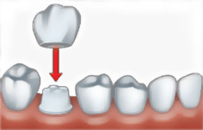 Bọc răng sứ đòi hỏi phải các mài răng khỏe mạnh bên cạnh