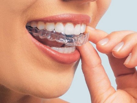 Niềng răng phương pháp thẩm mỹ được ưa chuộng nhất