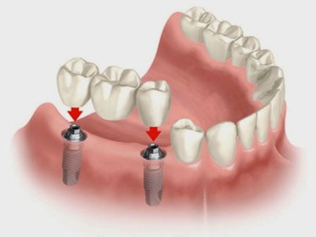 Phục hình răng hàm để duy trì chức năng nhai