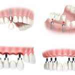 Nên trồng Implant hay bọc răng sứ thẩm mỹ tại Nha Khoa?