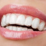 Sử dụng khay nhựa để điều trị niềng răng