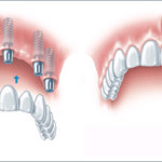Bảng giá làm răng implant tại nha khoa Đăng Lưu