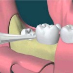 Nhổ răng khôn có ảnh hưởng xấu đến sức khỏe không?