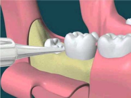 Nhổ răng khôn có ảnh hưởng xấu đến sức khỏe không ?