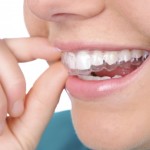 Niềng răng tháo lắp có hiệu quả không?