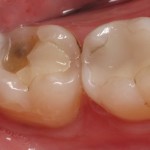 Bọc răng sứ cho răng hàm