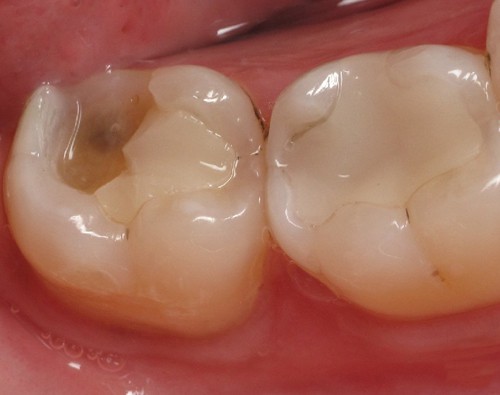 Bọc răng sứ cho răng hàm bằng răng sứ thẩm mỹ