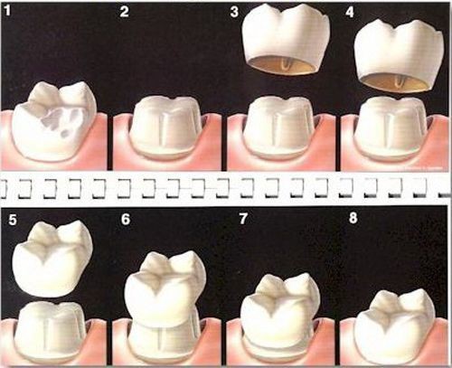 Mô hình bọc răng sứ cho răng hàm
