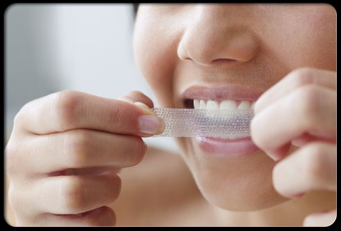 Có nên tự tẩy trắng răng ở nhà không ?
