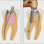 Răng cần điều trị tủy khi bị sâu răng ăn vào tủy răng. Việc điều trị tủy răng lúc này là hết sức cần thiết bởi răng bị viêm tủy sẽ bị đau nhức và viêm nhiễm nặng. Sau khi điều trị tủy xong răng được gọi là chết tủy. Vậy, Có nhất thiết phải phục hình răng sứ cho răng chết tủy. Bài viết của chúng tôi sẽ cung cấp thông tin để bạn hiểu thêm về vấn đề này. Vì sao phải điều trị tủy răng ? Tủy răng là phần mạch sống nằm chính giữa bao gồm các mạch máu và dây thần kinh để nuôi dưỡng răng. Phần tủy răng được bao bọc bởi hai lớp men và ngà răng ở bên ngoài thân răng. Tủy răng được bao bọc và nuôi dưỡng trong thân răng tuy nhiên do quá trình sâu răng quá nặng dẫn đến viêm tủy răng và “chết tủy”. Khi tủy bị viêm sẽ gây ra hiện tượng đau đớn, ê buốt răng. Khi bị viêm, tủy răng đã không còn tác dụng nuôi dưỡng răng nữa mà như một ổ vi khuẩn khiến việc viêm nhiễm, sâu răng càng trầm trọng hơn vì vậy phải điều trị loại bỏ phần tủy này đi. Quy trình điều trị tủy răng nhằm làm sạch ống tủy, loại bỏ những phần tủy đã bị nhiễm trùng và trám bít ổng tủy Có nhất thiết phải phục hình răng sứ cho răng chết tủy Sau khi điều trị, phần tủy bị hư hại đã bị loại bỏ đi nên bạn sẽ không phải chịu những cơn đau do viêm nhiễm nữa. Tuy nhiên, sau khi điều trị tủy răng, răng bạn sẽ trở nên giòn và dễ vỡ hơn. Đặc biệt, sau khi răng chết tủy rồi thì sau một thời gian nó sẽ bị sừng hóa và vì không còn tủy đễ duy trì sự sống cho răng nên bị mục dần, răng rất dễ gãy hoặc vỡ, nứt…khi có bất kỳ một va chạm nhẹ nào. Răng chết tủy sẽ không còn chức năng trong việc nhai thức ăn mà còn đặc biệt nguy hiểm khi nó có thể ảnh hưởng đến các răng khác.Vì vậy, sau khi điều trị tủy răng, bạn nên phục hình răng sứ cho răng chết tủy ngay. Việc phục hình răng sứ cho chiếc răng chết tủy không những giúp duy trì sức nhai cho răng mà còn đảm bảo tính thẫm mỹ cho khuôn miệng, hạn chế các bệnh răng miệng do việc vệ sinh răng miệng sẽ thuận lợi hơn. Điều trị tủy là một yêu cầu bắt buộc để loại bỏ phần tủy hư giúp răng được khỏe mạnh. Sau khi điều trị tủy răng bạn nên bọc răng sứ cho răng chết tủy để đảm bảo chức năng nhai cho hàm răng. Bạn nên đến cơ sở nha khoa uy tín để được BS tư vấn thêm về điều trị và phục hình răng sứ cho răng chết tủy.