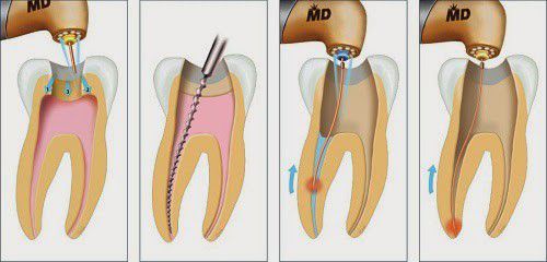 Có nhất thiết phải phục hình răng sứ cho răng chết tủy