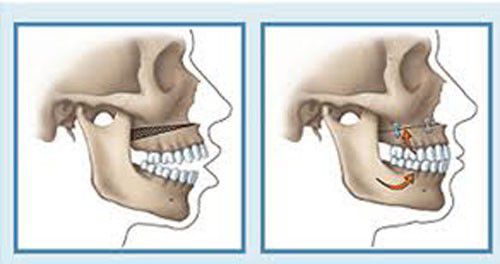 Điều trị răng hô không cần niềng răng có được không ?