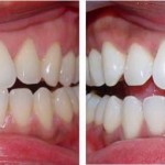 Những chia sẻ về răng sứ không kim loại thẩm mỹ làm đẹp