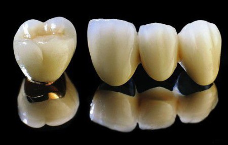 Răng sứ gắn lên trên Implant