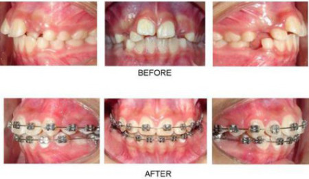 Hình ảnh trước và sau niềng răng khểnh
