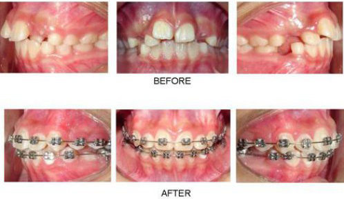 Hình ảnh trước và sau khi niềng răng