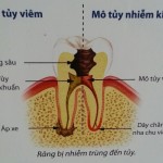 Răng đã lấy tủy thì tồn tại được bao lâu ?