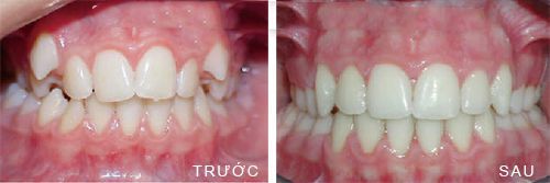 Hình ảnh trước và sau khi niềng răng