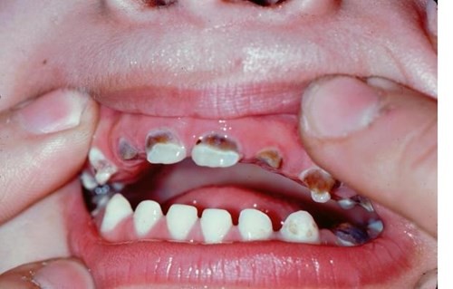Bạn nên điều trị dứt điểm nếu không sâu răng sẽ tái phát