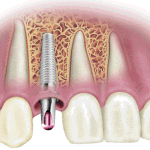 Răng Implant giá bao nhiêu?