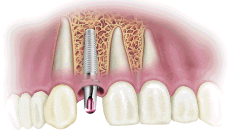 Implant sẽ được thực hiện ngay vị trí răng bị mất