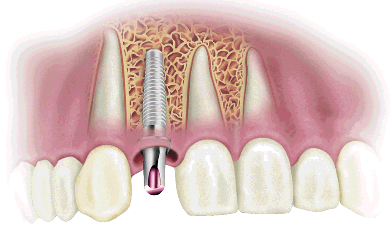 Răng Implant giá bao nhiêu?