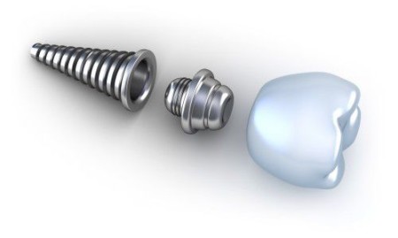 Cấu tạo của một chiếc răng Implant
