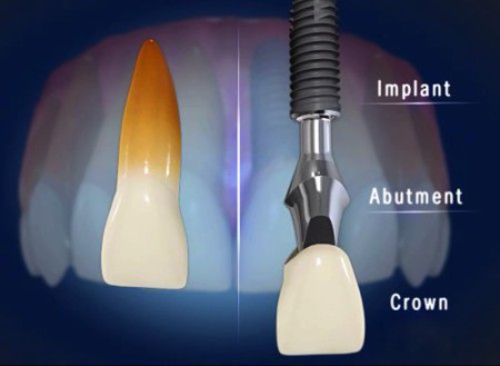 Cấu trúc của răng Implant