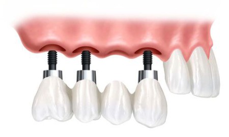 Trồng răng implant giá bao nhiêu tiền ?