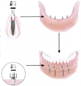 Làm răng implant tại nha khoa Đăng Lưu