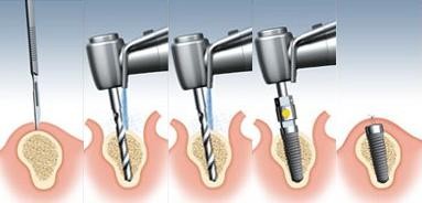 Quá trình khoan ghép Implant vào xương hàm