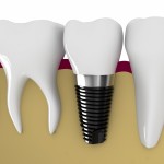 Cấy ghép Implant cho người bị mất răng