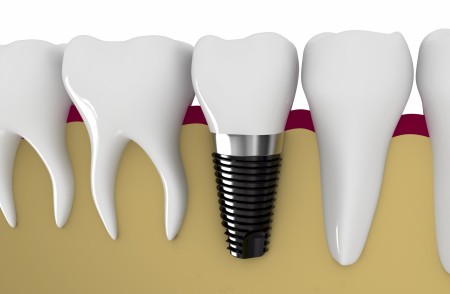 Răng cấy ghép Implant có trụ làm bằng chất liệu Titan