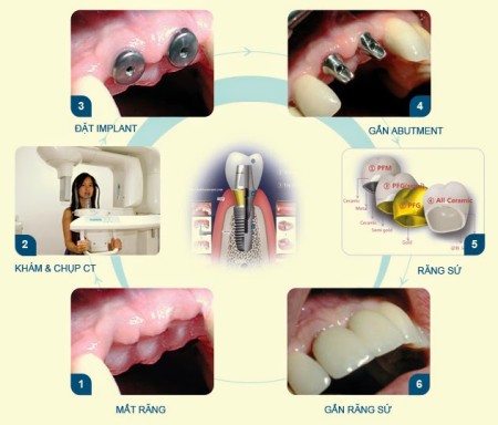 Giá răng implant tại nha khoa Đăng Lưu