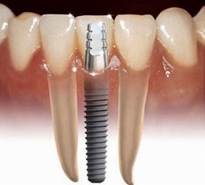 Trồng răng giả cố định bằng cách trồng răng Implant