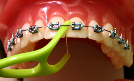 Niềng răng hiệu quả tại nha khoa Đăng Lưu